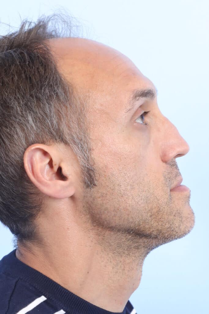 Before Image: Rhinoplasty - right-side