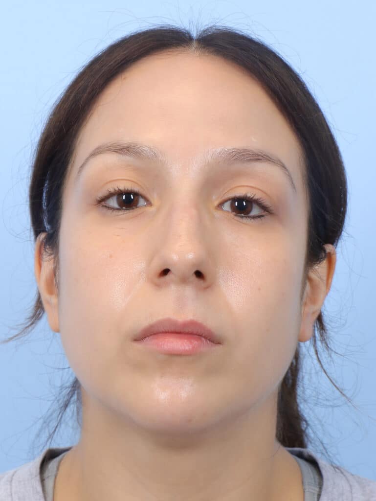 Before Image: Rhinoplasty - other