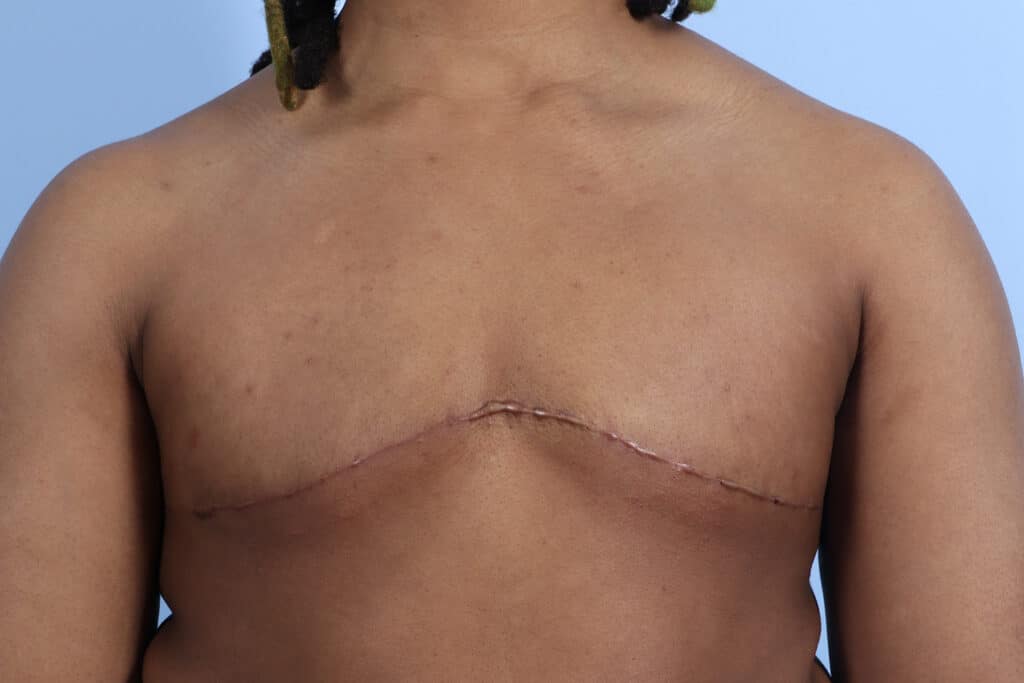 After Image: Double Incision Mastectomy - front