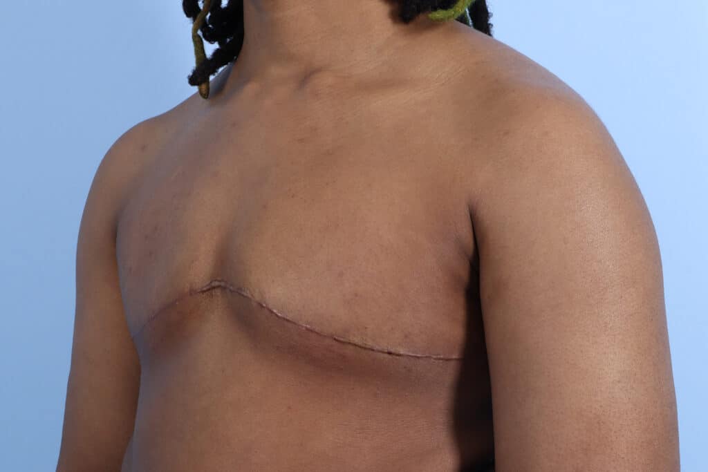 After Image: Double Incision Mastectomy - left-front-oblique