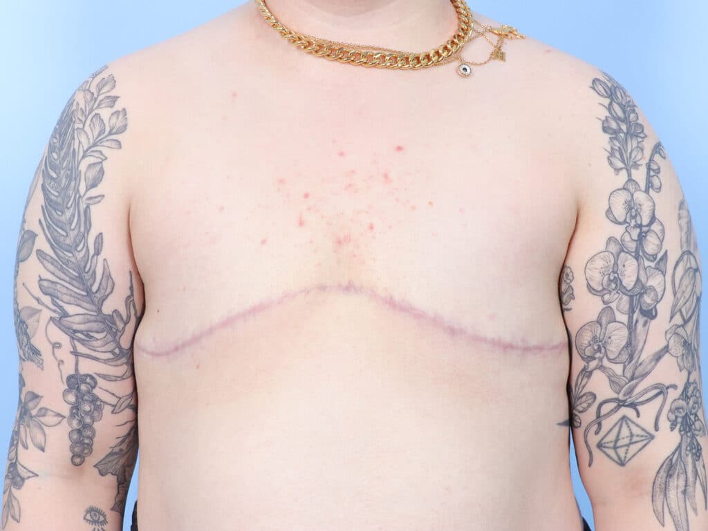 After Image: Double Incision Mastectomy - front