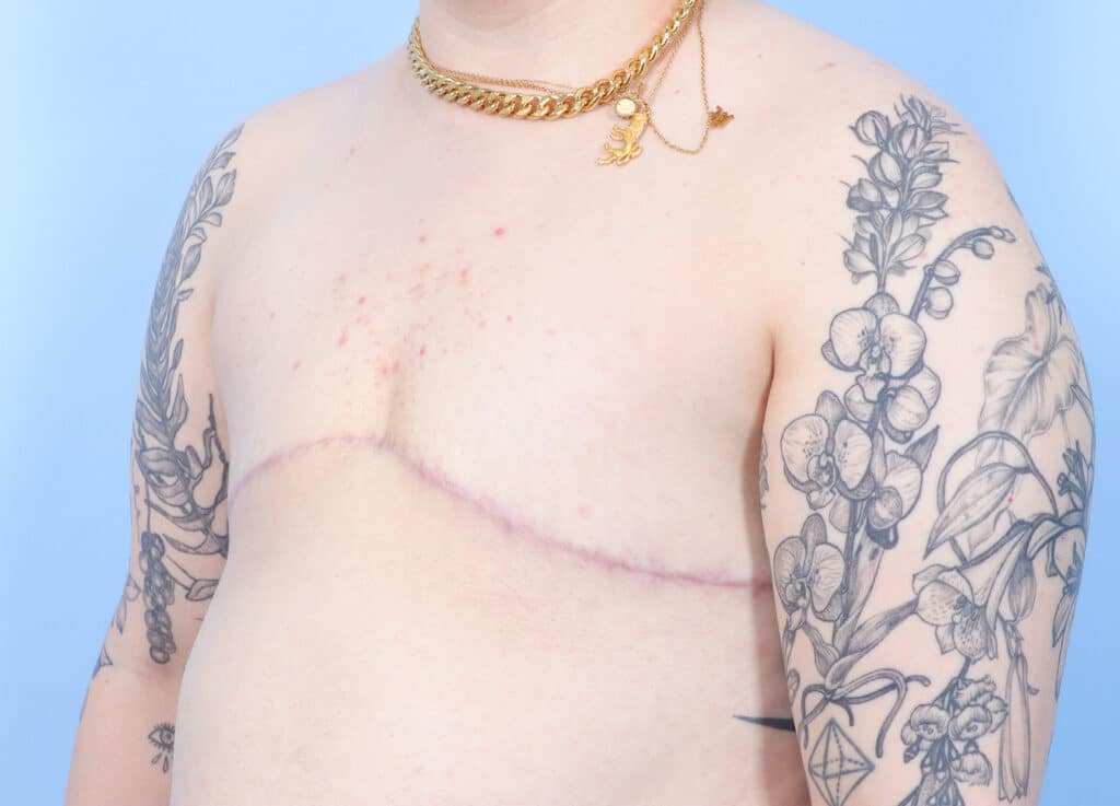 After Image: Double Incision Mastectomy - left-front-oblique