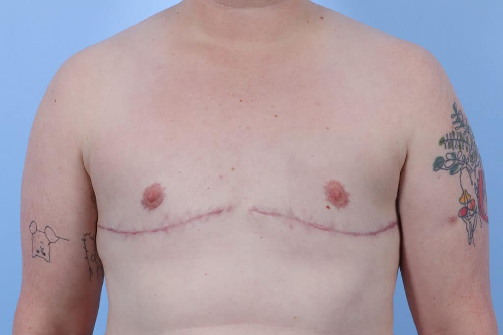 After Image: Double Incision with Nipple Grafts - front