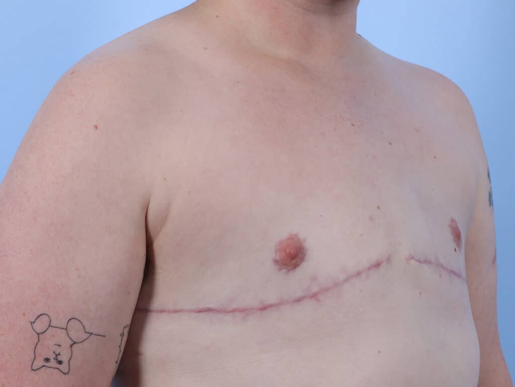 After Image: Double Incision with Nipple Grafts - right-front-oblique