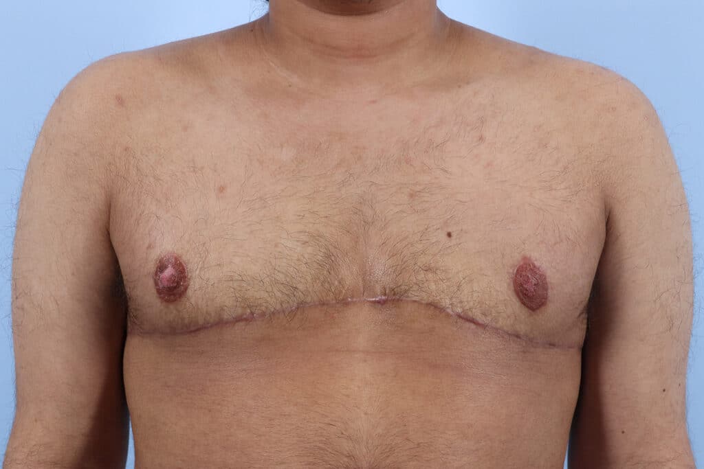 After Image: Double Incision with Nipple Grafts - front