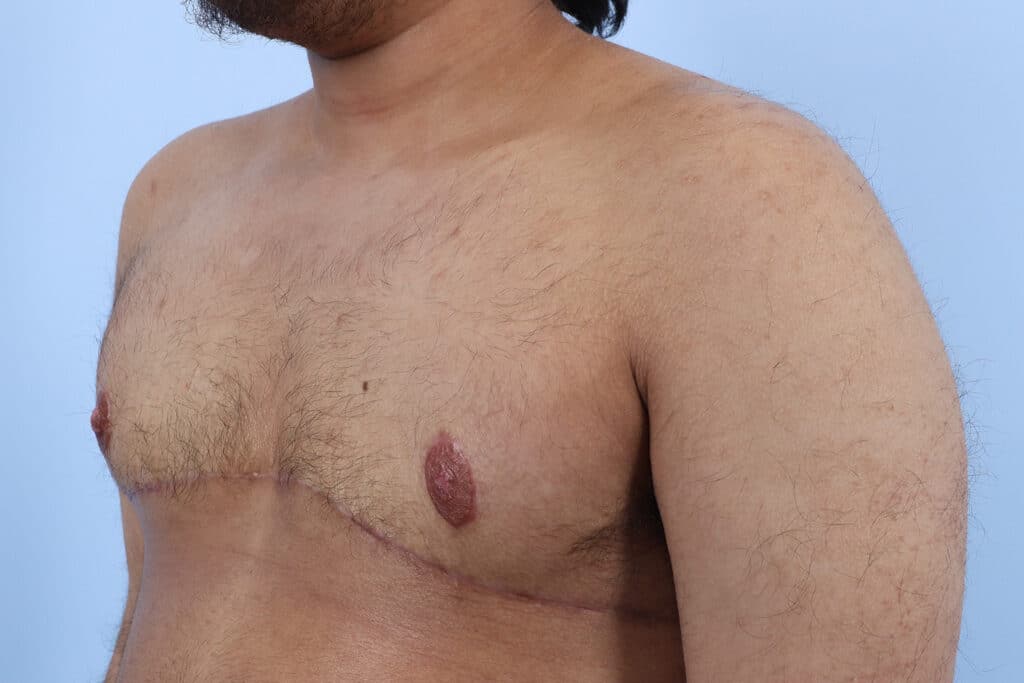 After Image: Double Incision with Nipple Grafts - left-front-oblique