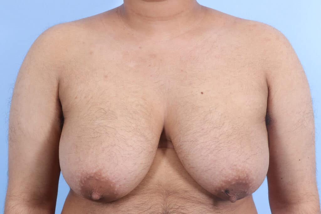 Before Image: Double Incision with Nipple Grafts - front