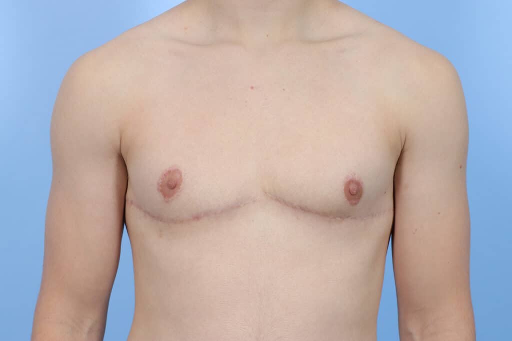 After Image: Inferior Wedge Mastectomy - front