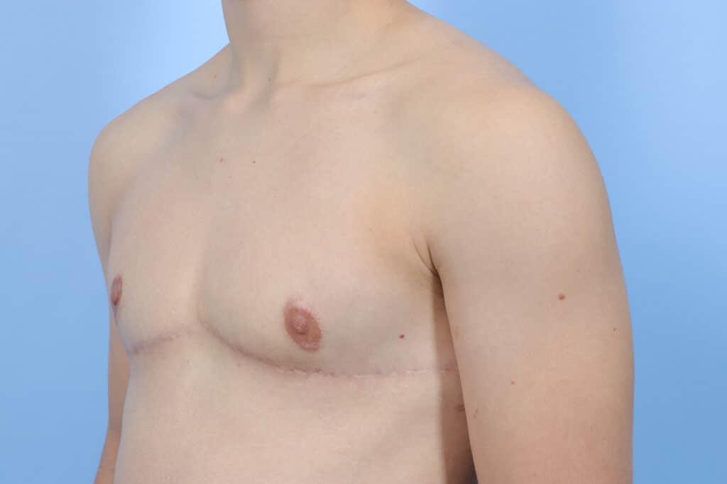 After Image: Inferior Wedge Mastectomy - left-front-oblique
